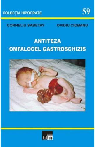 Antiteza omfalocel gastroschizis - Corneliu Sabetay - Ovidiu Ciobanu